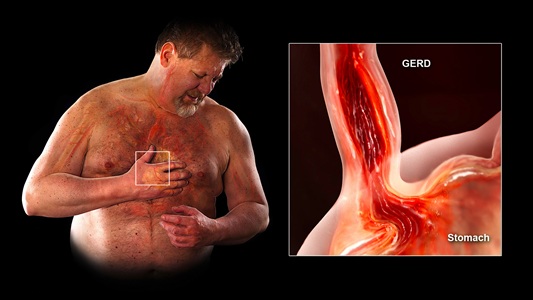 10 Health Facts About Acid Reflux