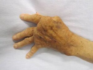 10 Health Facts About Arthritis